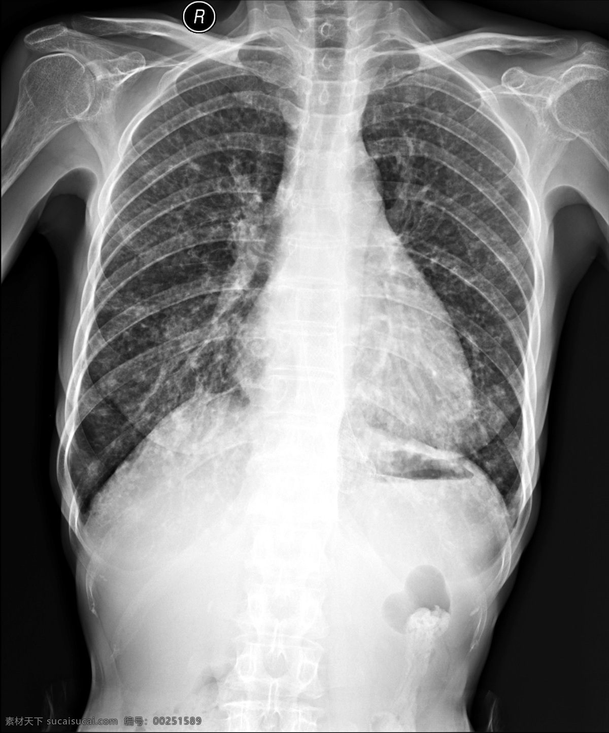 x线胸部拍片 x线 拍片 胸片 胸部 肋骨 心肺 x线照片 支架 关节 骨质 医疗 医药 医学 钢板内固定器 医疗护理 现代科技