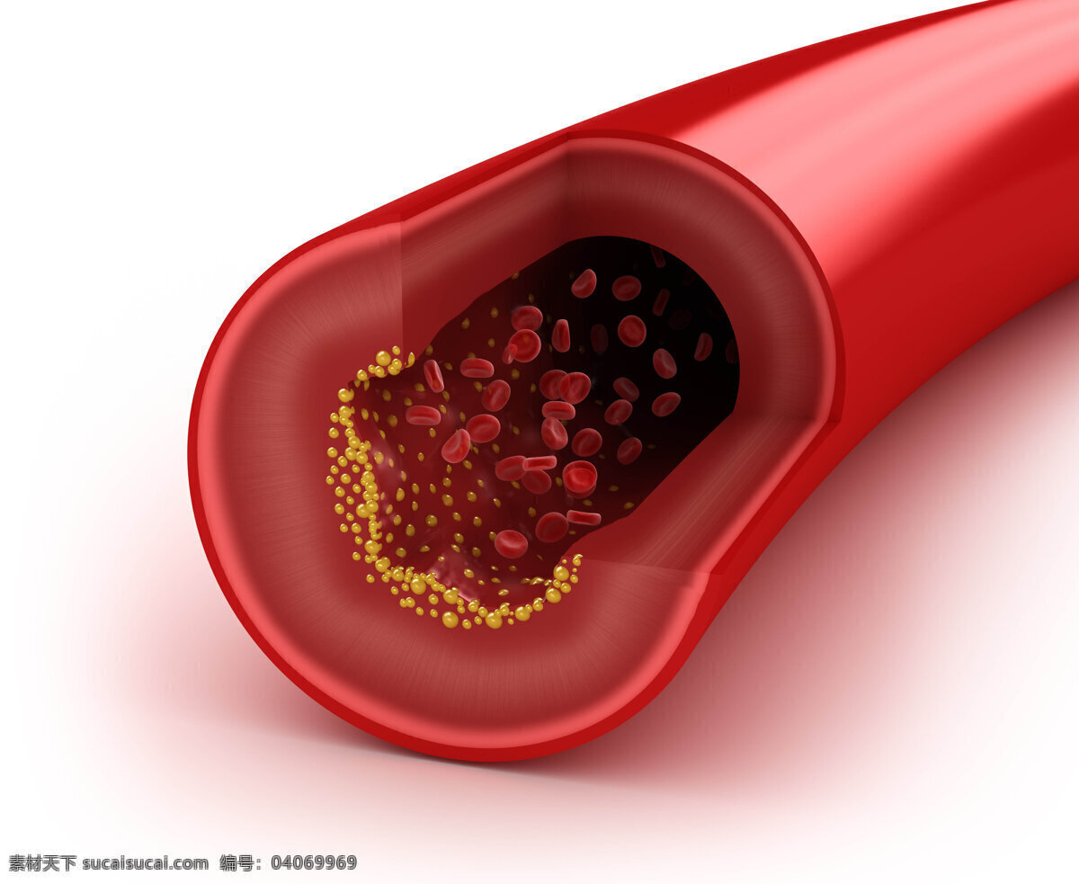 动脉粥样硬化 动脉 血红细胞 血管 粥样动脉硬化 3d 医学研究 血液 科学 显微状态 现代科技 医疗护理