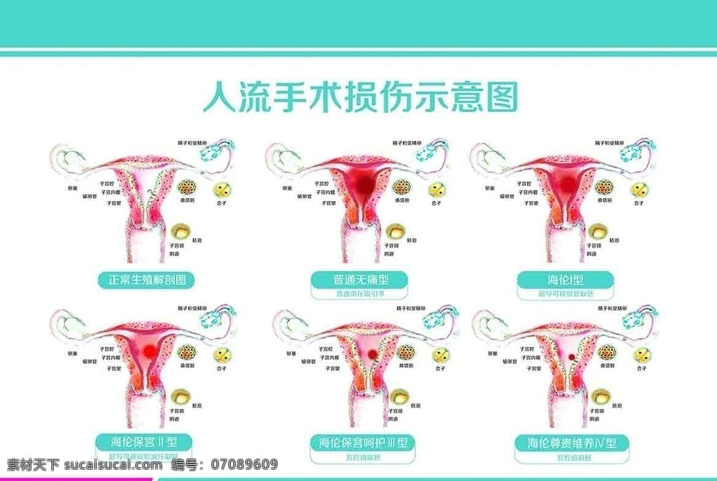 妇科 人流 手术 损伤 示意图 子宫 设计素材