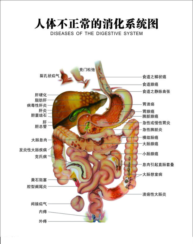 人体 不 正常 消化系统 图 消化系统图 人体内部 人体器官 医疗